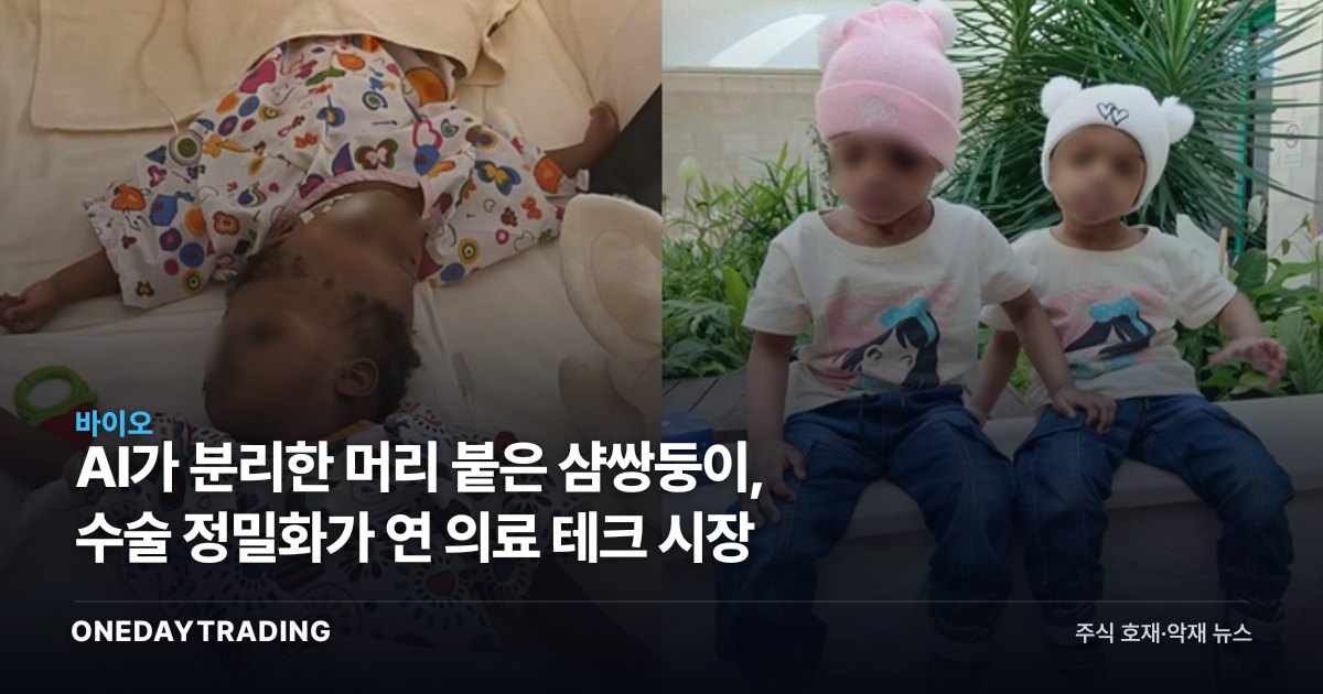 AI가 분리한 머리 붙은 샴쌍둥이, 수술 정밀화가 연 의료 테크 시장